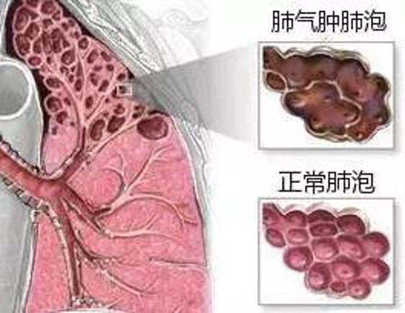 肺气肿能治好吗