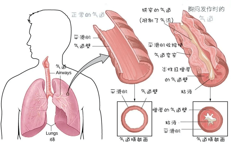 济南哮喘治疗的新希望