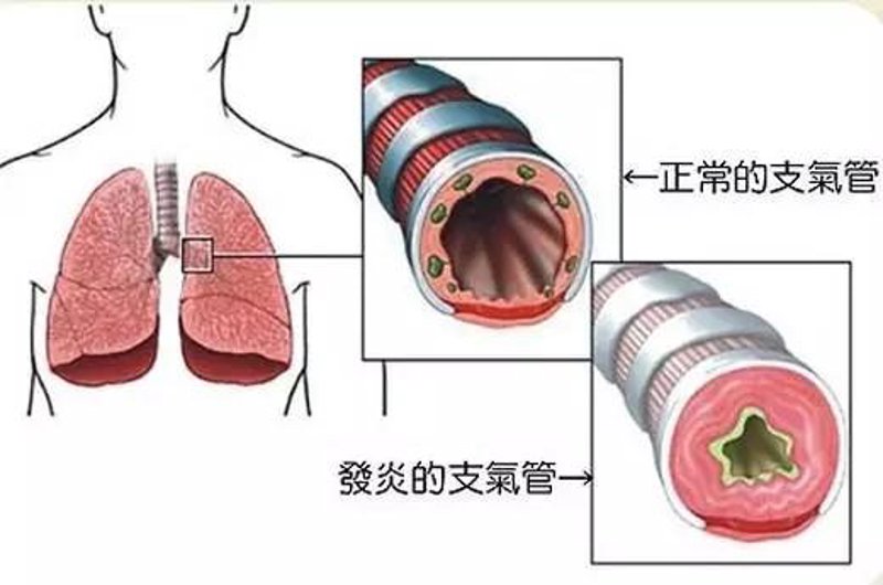 支气管炎怎么治
